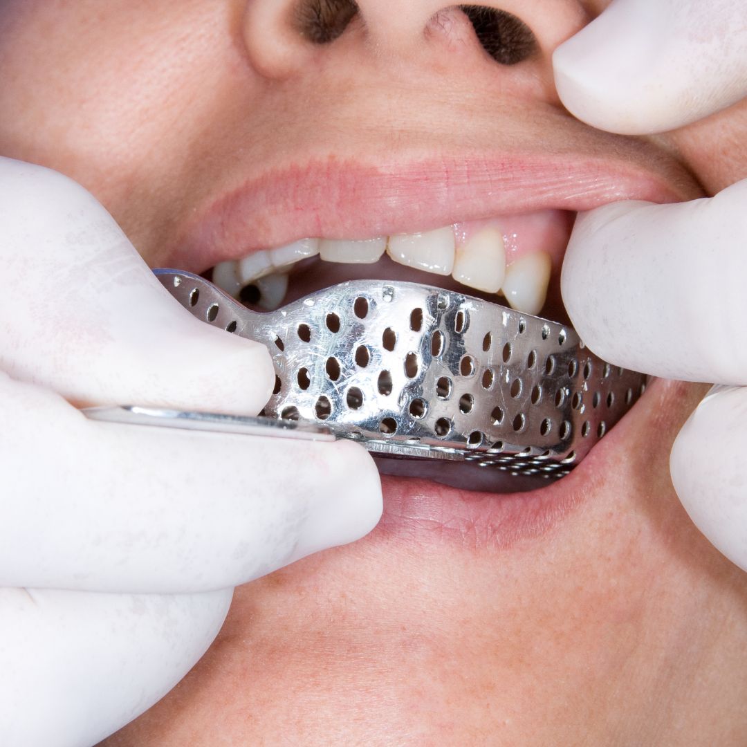 Oral rehabilitation process, partial removable prosthesis