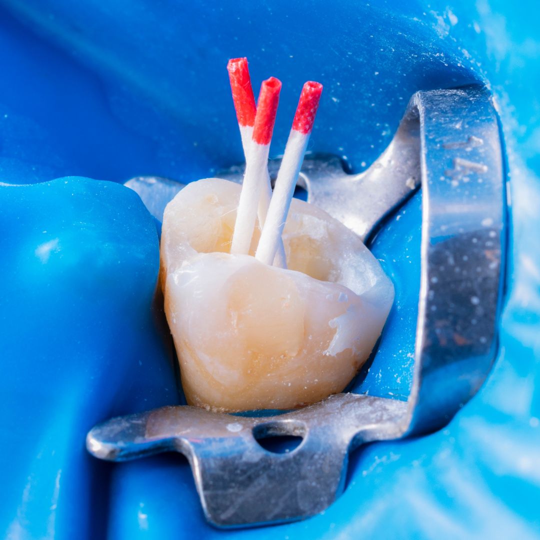 Tooth in root canal treatment