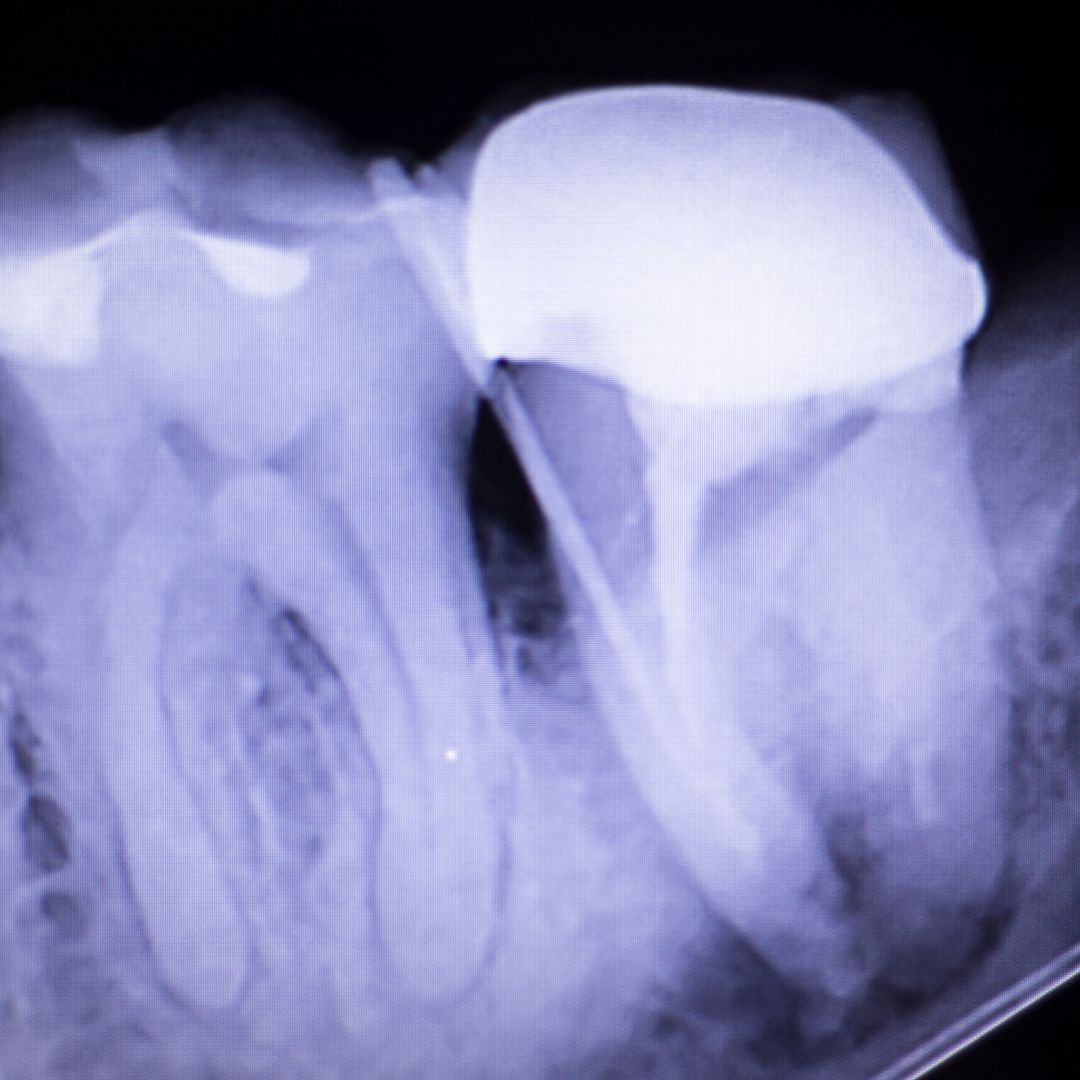 Dental xray test scan of tooth with crown filling