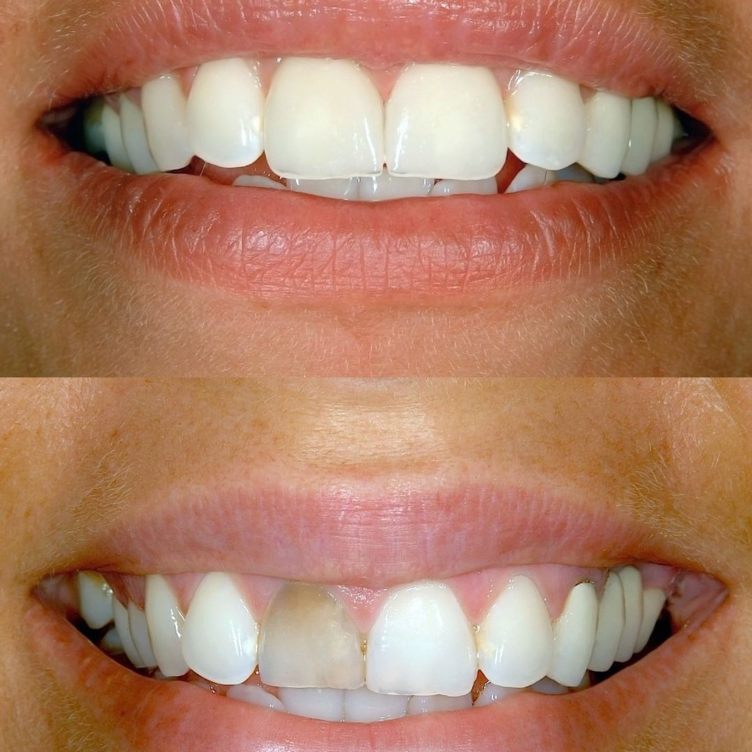 Before and after smile design dental procedure